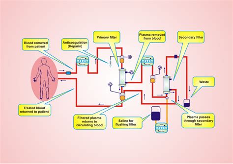 Double-filtration plasmapheresis (DFPP) is a filter-based therapeutic ...