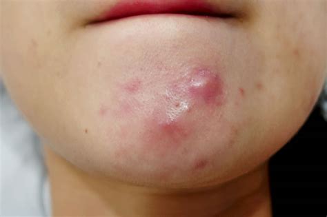 Cystic Acne Causes & Best Treatment To Get Rid of Cystic Acne On Chin