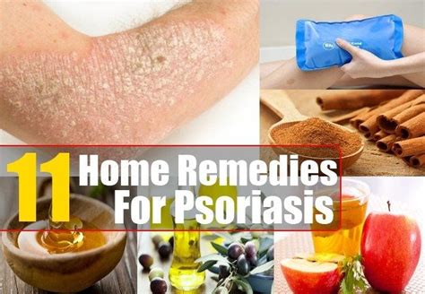 Home Remedies For Psoriasis – Natural Treatments & Cure For Psoriasis ...