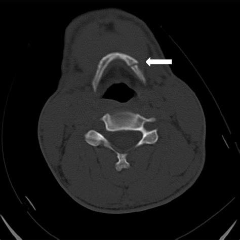 (PDF) Isolated hyoid bone fracture after motorcycle collision