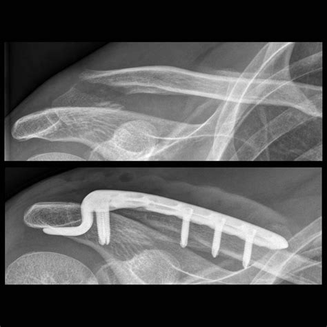 Medartis on Twitter: "#FractureFriday 50 years-old patient with a ...