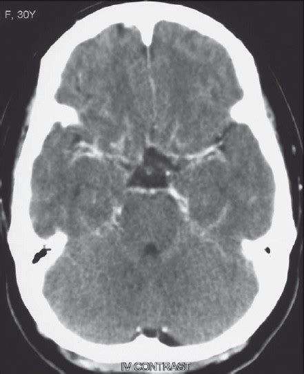 Contrast-enhanced CT scan at the level of the basal cisterns, showing ...