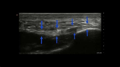 Plantar Fasciitis Ultrasound - YouTube