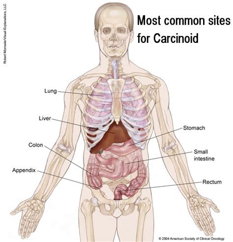 Carcinoid