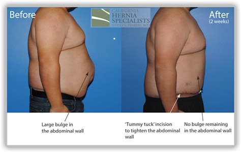 Hernia Types - Recurrent - California Hernia Specialists