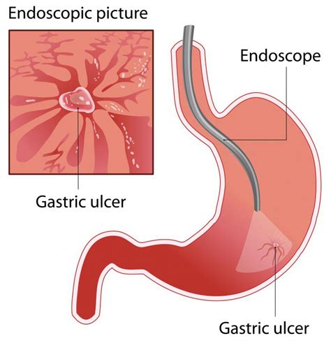 What Is the Treatment for a Curling's Ulcer? (with pictures)