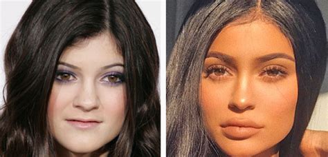 Kylie Jenner Is Refused Lip Fillers Due To Her Pregnancy & Is Now ...