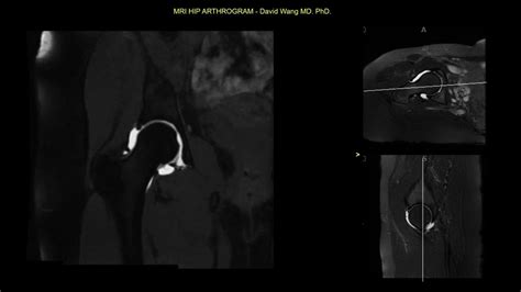 Hip Arthrogram MRI Anatomy Atlas (unlabeled) - YouTube