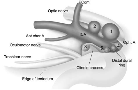 Ruptured carotid artery aneurysms of the ophthalmic (C6) segment ...