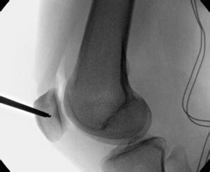 MPFL Reconstruction | Musculoskeletal Key