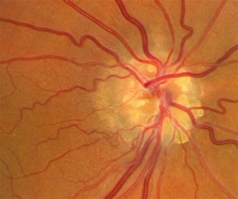 What Are Drusen And Yellow Eye: Causes And Diagnosis