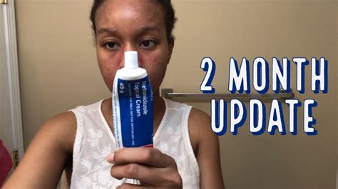 2 month Update Review of Metronidazole Cream for my Perioral Dermatitis ...