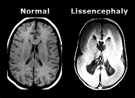 Lissencephaly