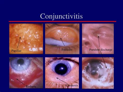 PPT - The Red Eye Differential Diagnosis PowerPoint Presentation - ID ...