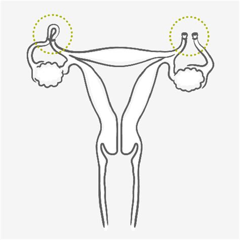 Sterilization - Permanent Method