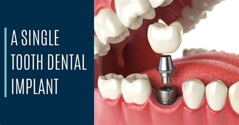 3 Types of Dental Implants | Which Implant Is Best for You? | Bellevue