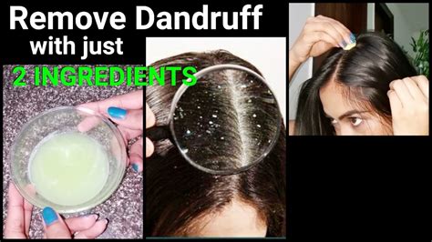 Natural Ways To Do Dandruff Treatment At Home - TOP 5 DIY