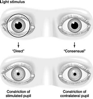 Hippus Pupil Reaction