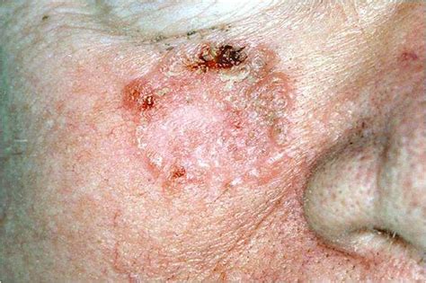 Skin cancer: what you need to know