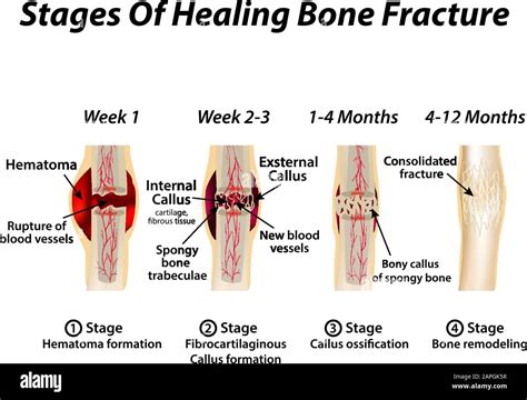 Stages Of Healing Bone Fracture. Formation of callus. The bone fracture ...