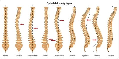 Spinal Deformities Houston | Houston Spine Dr. Martin