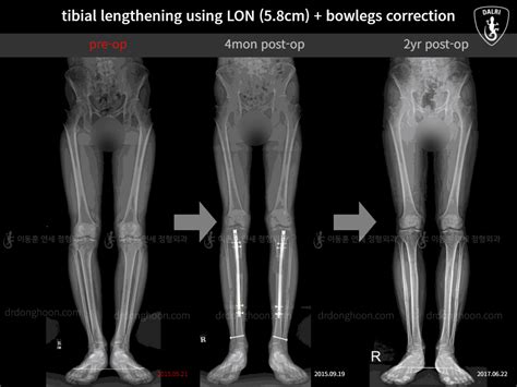 tibial lengthening using LON (5.8cm) + bowlegs correction : 2yr post-op ...