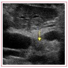 Fulltext | Duplex Ultrasound in the Diagnosis of Liver Tumors