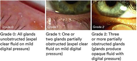 How to manage patients with Meibomian Gland Dysfunction (MGD)