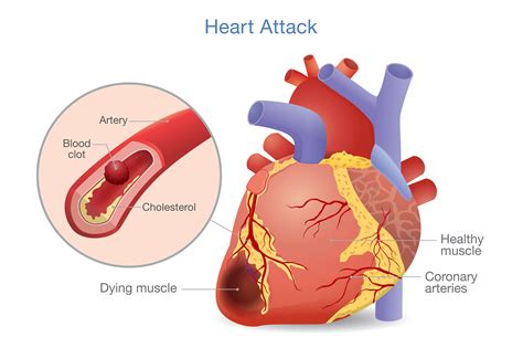 Time to reassess fluids for chronic heart failure patients