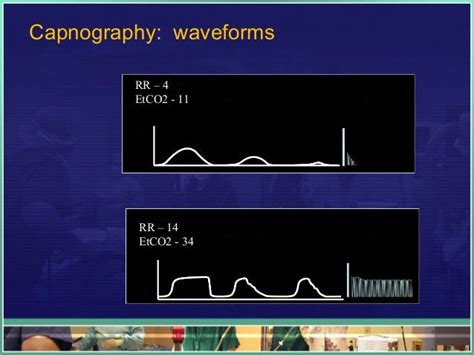 CC - EtCO2 and Waveform Capnography