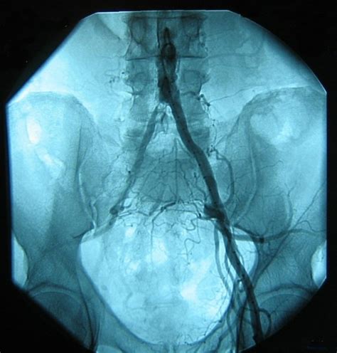 Intermittent claudication is leg pain brought on by exercise.