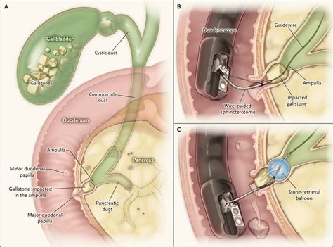 ERCP | Endoscopic Retrograde Cholangiopancreatography