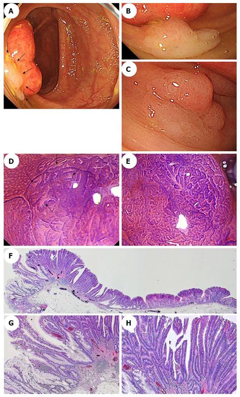 Sessile Serrated Adenoma Syndrome - Quotes Resume