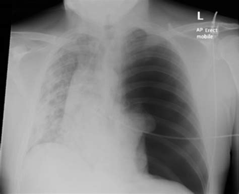 Left Pneumothorax X Ray