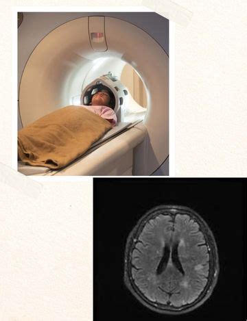 MRI scan for Brain Stroke Protocol | Hyderabad | Medintu