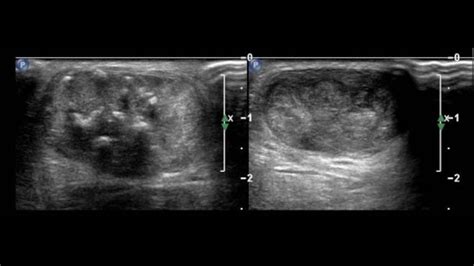 Tendon and Ligament Ultrasound - Internet Book Of MSK Ultrasound