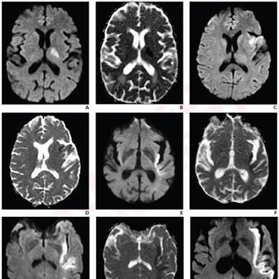 Stroke indicator found on MRI could help with treatment strategies ...