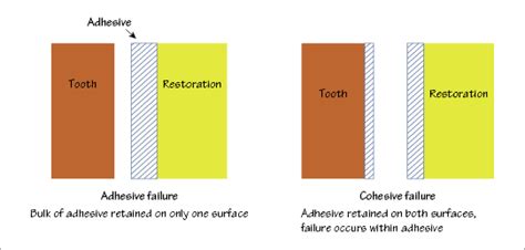 4: Adhesion and cohesion | Pocket Dentistry