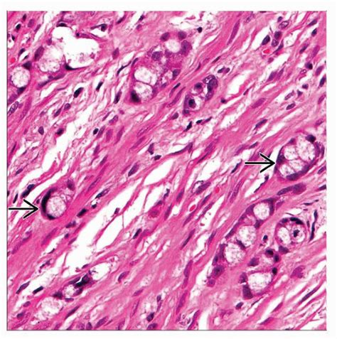 Goblet Cell Carcinoid/Mixed Adenocarcinoma-Carcinoid | Basicmedical Key