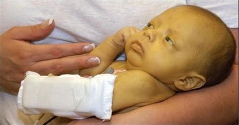 Jaundice In Newborns - Causes, Symptoms And Treatment