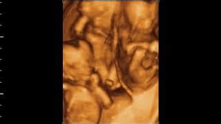 Ultrasound Quintuplets