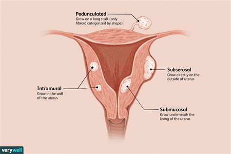 Top 122+ Fibroid uterus animation - Merkantilaklubben.org