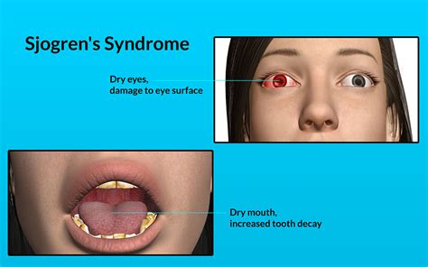 Sjogren's Syndrome|Causes|Risk Factors|Signs|Symptoms|Investigations ...