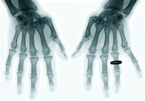 Osteoarthritis Of The Thumb Photograph by Zephyr/science Photo Library ...