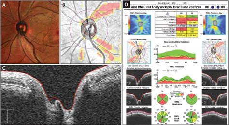 Evaluating the Optic Nerve for Glaucomatous Damage With OCT - Glaucoma ...