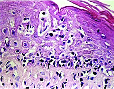 Mycosis Fungoides Histology