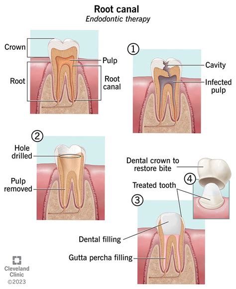 Root Canal: Procedure, What It Treats & Recovery