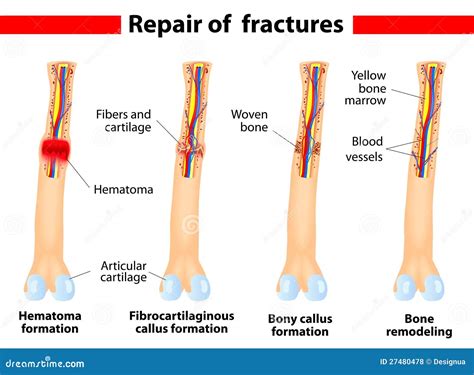 fracture healing stages