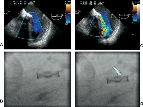 Figure 1 from ARTICLE IN PRESS Cyclic Intermittent Aortic Regurgitation ...