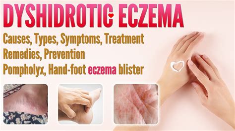 My Experience With Dyshidrotic Eczema (Pompholyx), 56% OFF